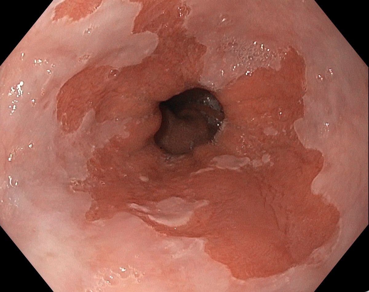 Endoscopic view of the lower oesophagus showing tongues of salmon coloured Barrett's lining reaching up into the paler normal lining